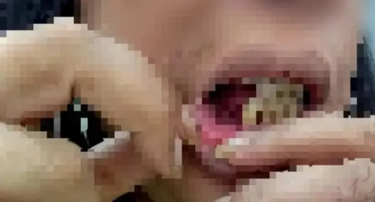 Homem é preso após espancar companheira brutalmente e arrancar dentes em RO